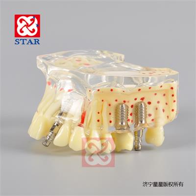 Implant Model With Caries M2007
