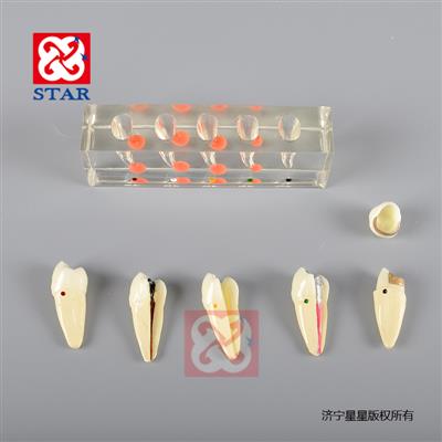 Endodontic Treatment Model M4007-2