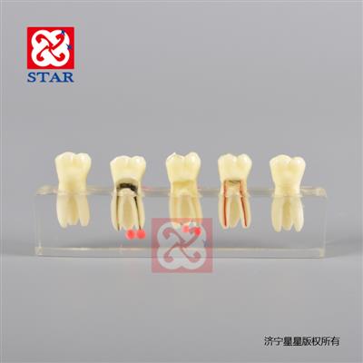 Root Canal Model M4012