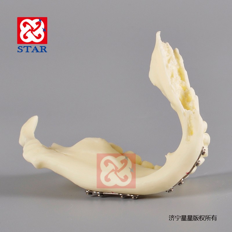Jaw Fracture Model M5001