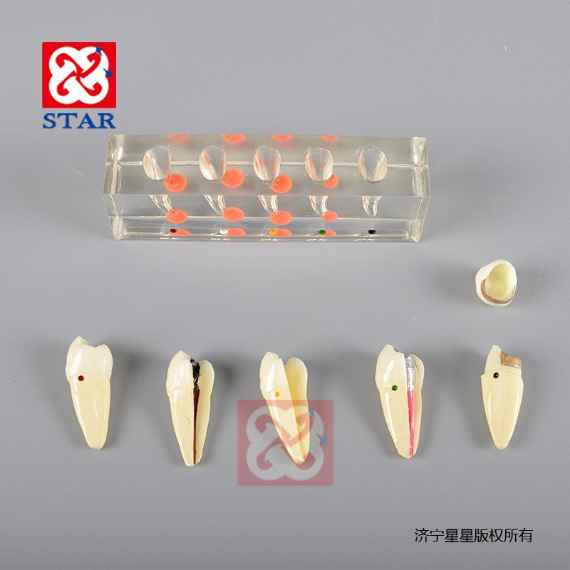 Endodontic Treatment Model M4007-2